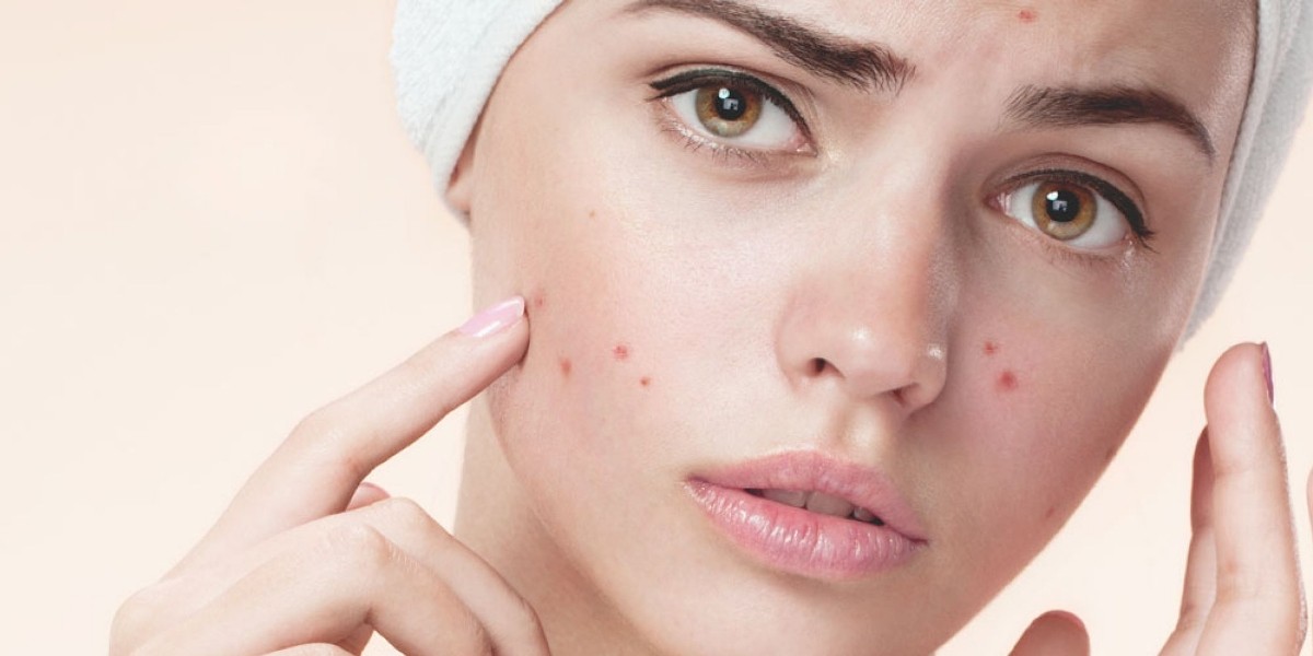 Best Skincare Routine for Acne Pore Skin